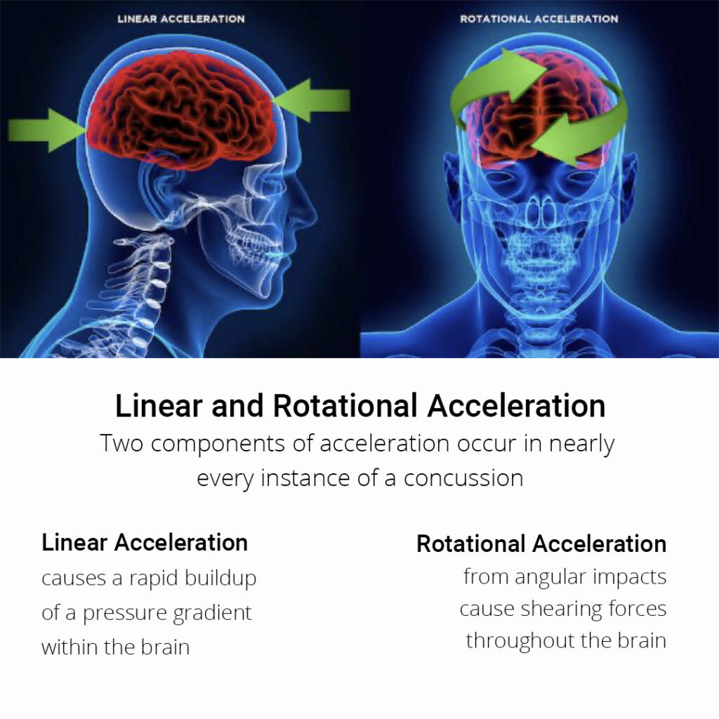 Linear and Rotational Acceleration in Concussions